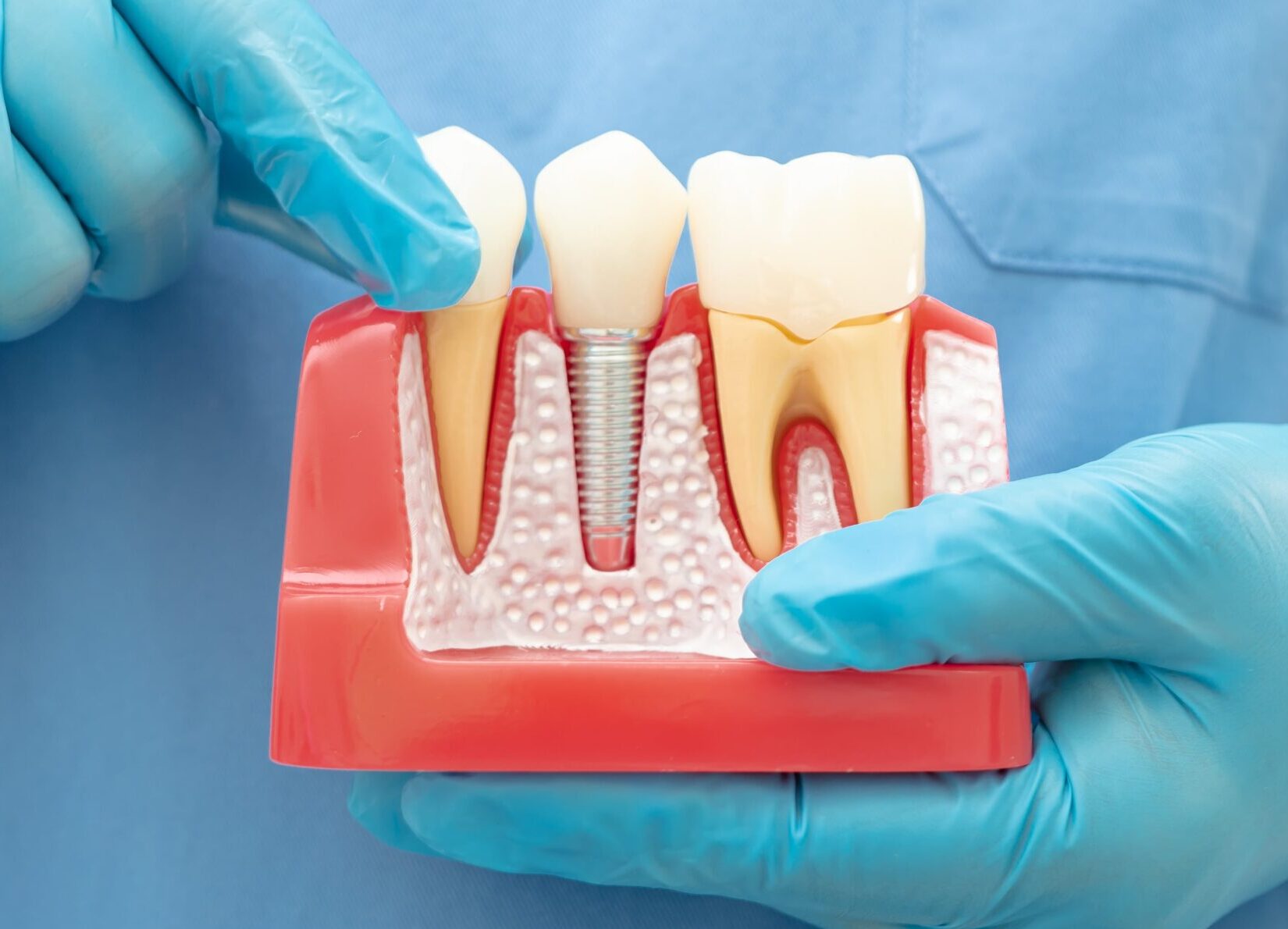Implantes dentales